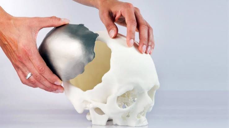 Cranial implant on skull model