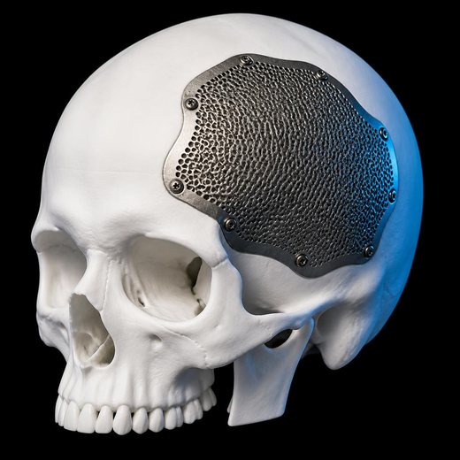 3D-printed Cranial implant
