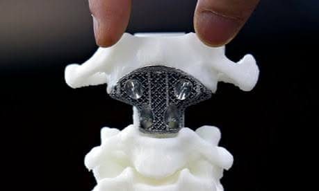 Cervical spine implant model
